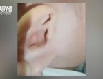 深圳1岁半幼儿模仿掏耳致耳膜破裂脑脊液流出